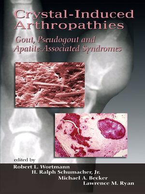 cover image of Crystal-Induced Arthropathies